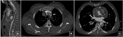 Surmounting the summit: tackling cerebral malperfusion in AMDS-treated acute deBakey I dissections. A case report